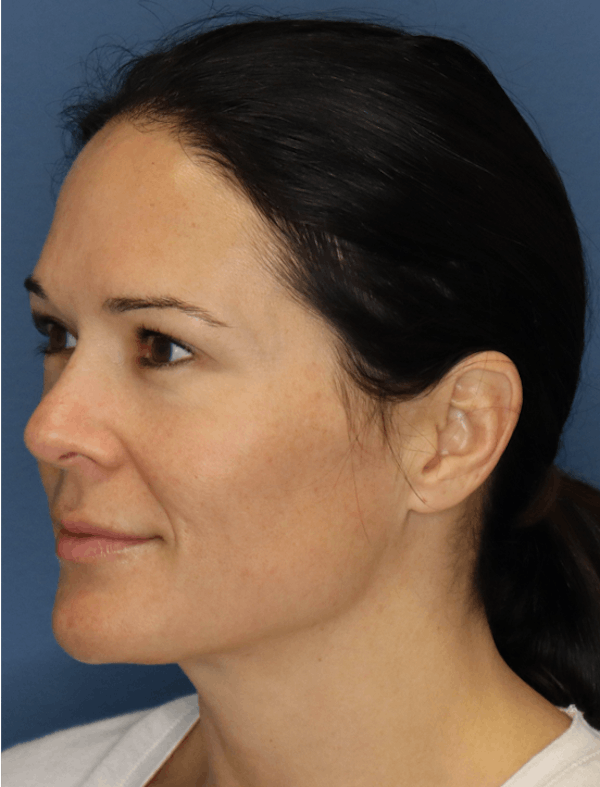 Halo Skin Resurfacing