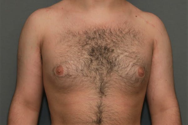 Gynecomastia Before & After Gallery - Patient 8284597 - Image 1