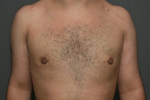 Gynecomastia Before & After Gallery - Patient 8284597 - Image 2