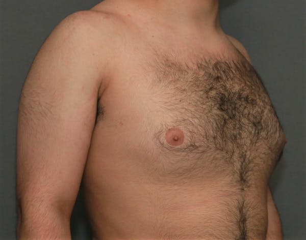 Gynecomastia Before & After Gallery - Patient 5157968 - Image 3