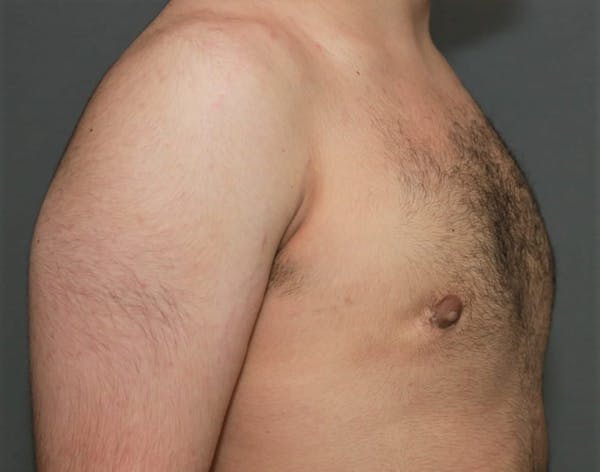 Gynecomastia Before & After Gallery - Patient 8284597 - Image 4
