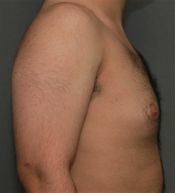 Gynecomastia Before & After Gallery - Patient 8284597 - Image 5