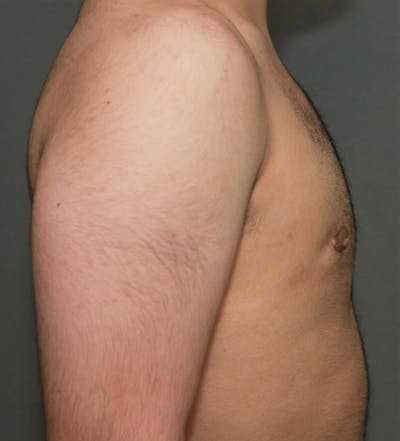 Gynecomastia Before & After Gallery - Patient 8284597 - Image 6