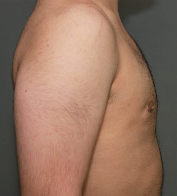 Gynecomastia Before & After Gallery - Patient 5157968 - Image 6