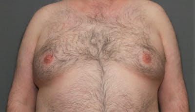 Gynecomastia Before & After Gallery - Patient 5157969 - Image 1