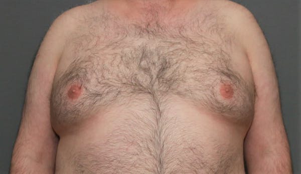 Gynecomastia Before & After Gallery - Patient 5157969 - Image 1