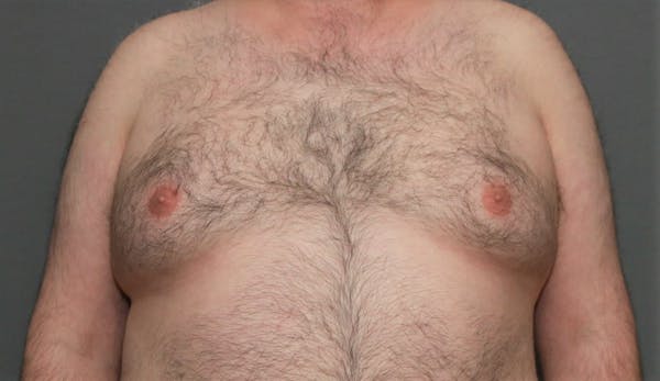 Gynecomastia Before & After Gallery - Patient 8284598 - Image 1