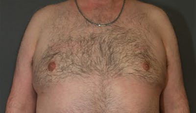 Gynecomastia Before & After Gallery - Patient 8284598 - Image 2