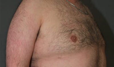 Gynecomastia Before & After Gallery - Patient 5157969 - Image 4