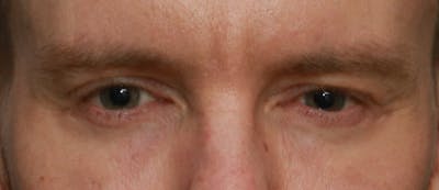 Lower Blepharoplasty Before & After Gallery - Patient 5158176 - Image 2