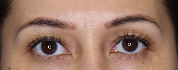 Upper Blepharoplasty Before & After Gallery - Patient 5158180 - Image 1