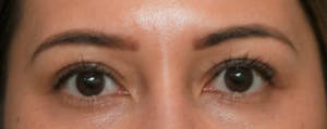 Upper Blepharoplasty in Orange County