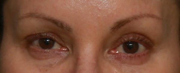 Upper Blepharoplasty Before & After Gallery - Patient 5158181 - Image 1