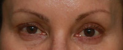 Upper Blepharoplasty Before & After Gallery - Patient 5158181 - Image 1