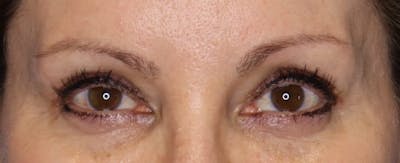 Upper Blepharoplasty Before & After Gallery - Patient 5158181 - Image 2