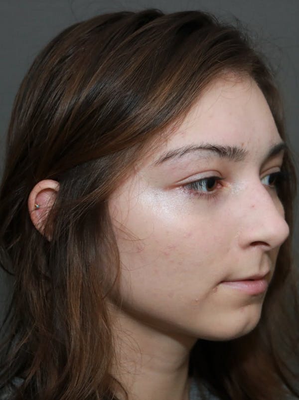 Aesthetic Rhinoplasty Before & After Gallery - Patient 5164566 - Image 3