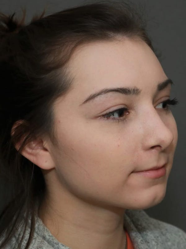 Aesthetic Rhinoplasty Before & After Gallery - Patient 5164566 - Image 4