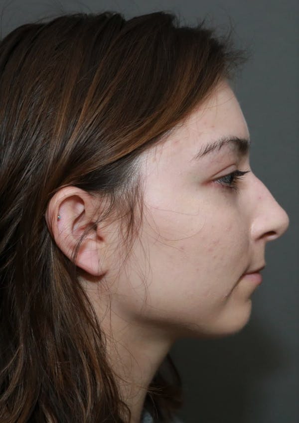Aesthetic Rhinoplasty Before & After Gallery - Patient 5164566 - Image 5