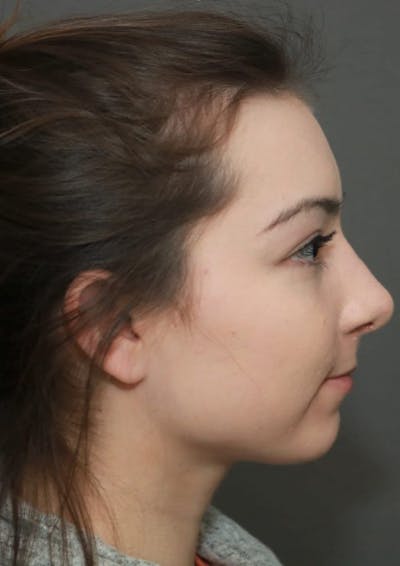 Aesthetic Rhinoplasty Before & After Gallery - Patient 5164566 - Image 6