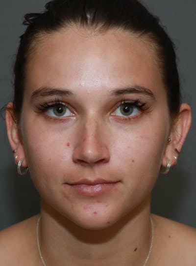 Aesthetic Rhinoplasty Before & After Gallery - Patient 5164567 - Image 1