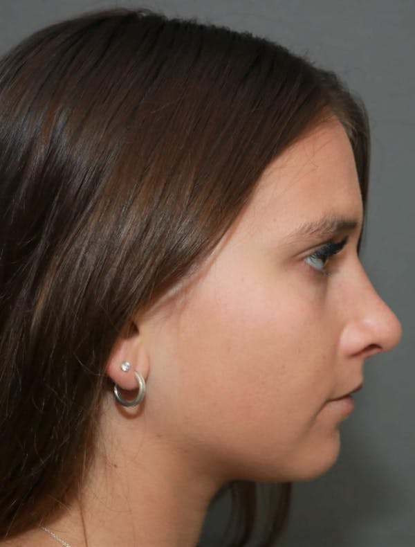 Aesthetic Rhinoplasty Before & After Gallery - Patient 5164567 - Image 6