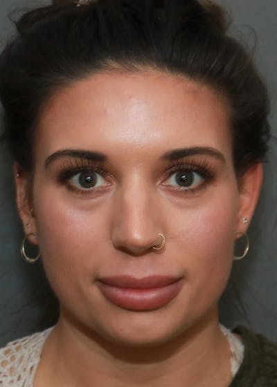 Aesthetic Rhinoplasty Before & After Gallery - Patient 5164568 - Image 1