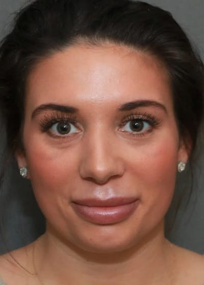 Aesthetic Rhinoplasty Before & After Gallery - Patient 5164568 - Image 2