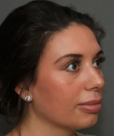 Aesthetic Rhinoplasty Before & After Gallery - Patient 5164568 - Image 4