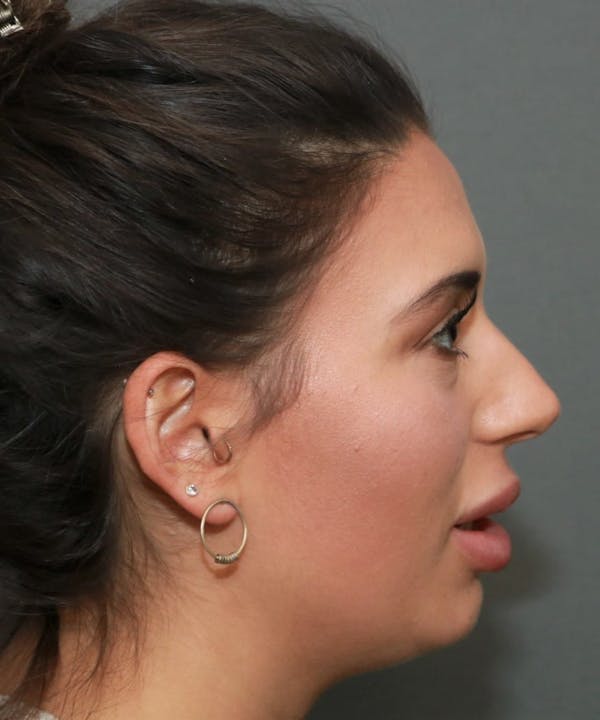 Aesthetic Rhinoplasty Before & After Gallery - Patient 5164568 - Image 5