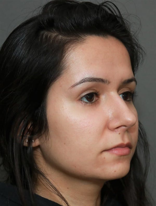 Aesthetic Rhinoplasty Before & After Gallery - Patient 5164569 - Image 3
