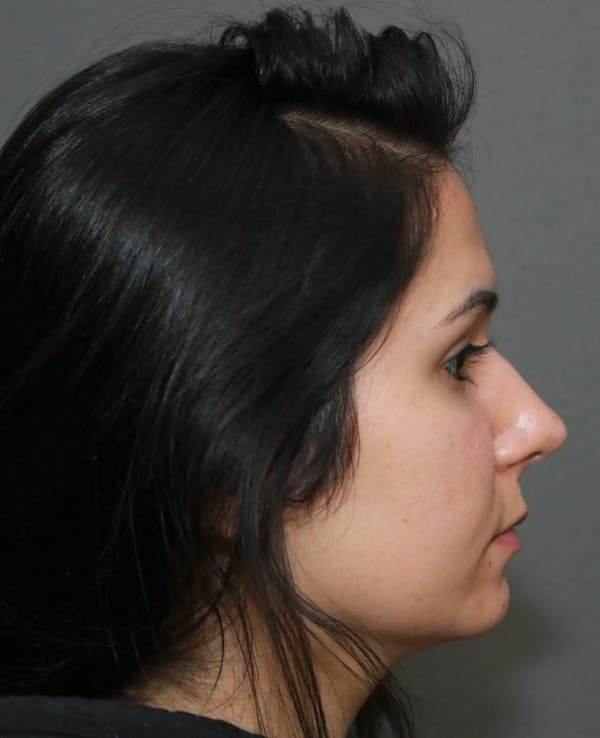 Aesthetic Rhinoplasty Before & After Gallery - Patient 5164569 - Image 5