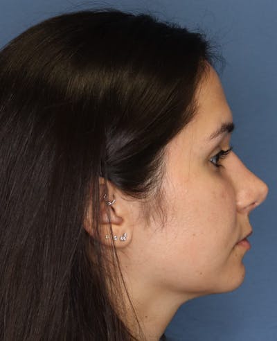 Aesthetic Rhinoplasty Before & After Gallery - Patient 5164569 - Image 6