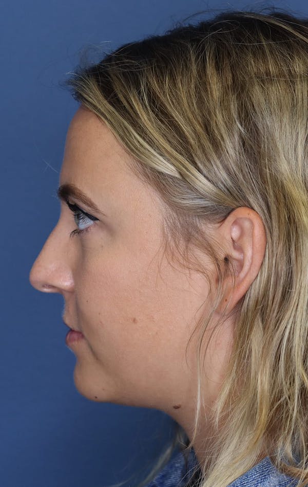 Aesthetic Rhinoplasty Before & After Gallery - Patient 5164570 - Image 5