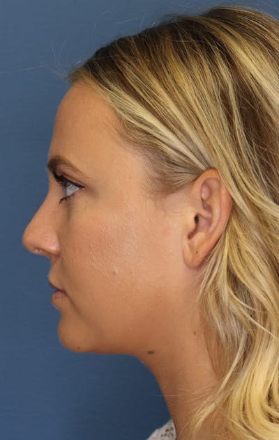 Aesthetic Rhinoplasty Before & After Gallery - Patient 5164570 - Image 6