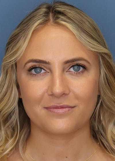 Aesthetic Rhinoplasty Before & After Gallery - Patient 5164570 - Image 2