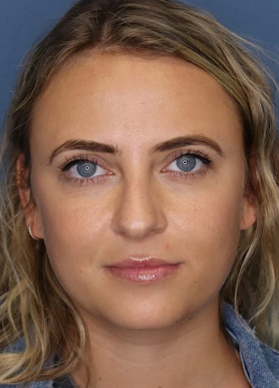 Aesthetic Rhinoplasty Before & After Gallery - Patient 5164570 - Image 1