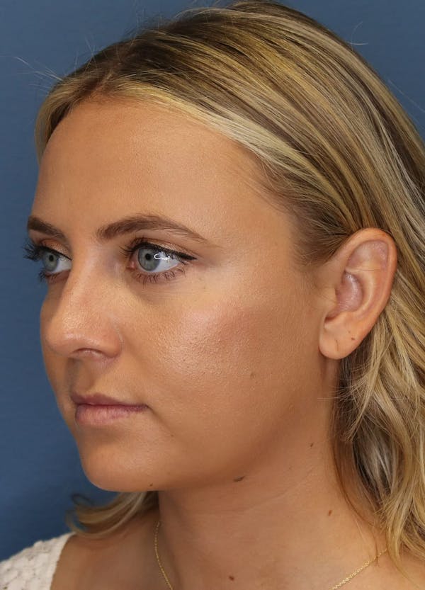 Aesthetic Rhinoplasty Before & After Gallery - Patient 5164570 - Image 4