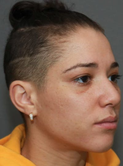 Functional Rhinoplasty Before & After Gallery - Patient 5164606 - Image 4