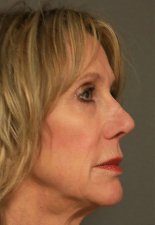 Revision Rhinoplasty Before & After Gallery - Patient 5164616 - Image 3