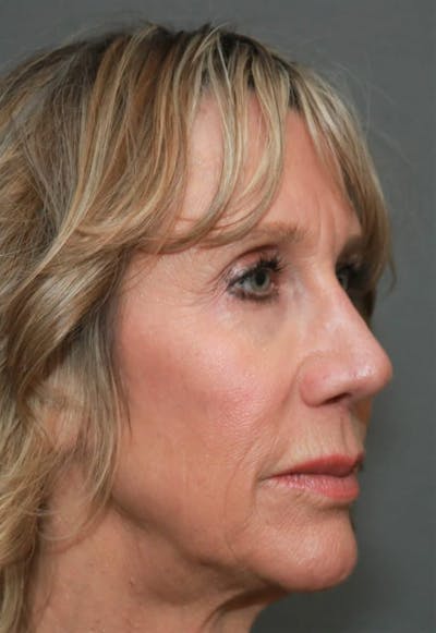 Revision Rhinoplasty Before & After Gallery - Patient 5164616 - Image 4