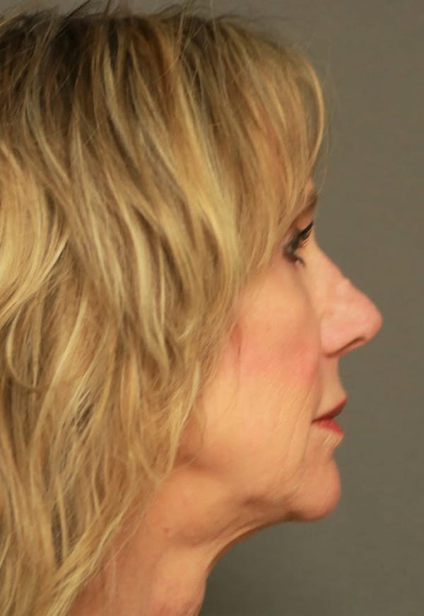 Revision Rhinoplasty Before & After Gallery - Patient 5164616 - Image 5