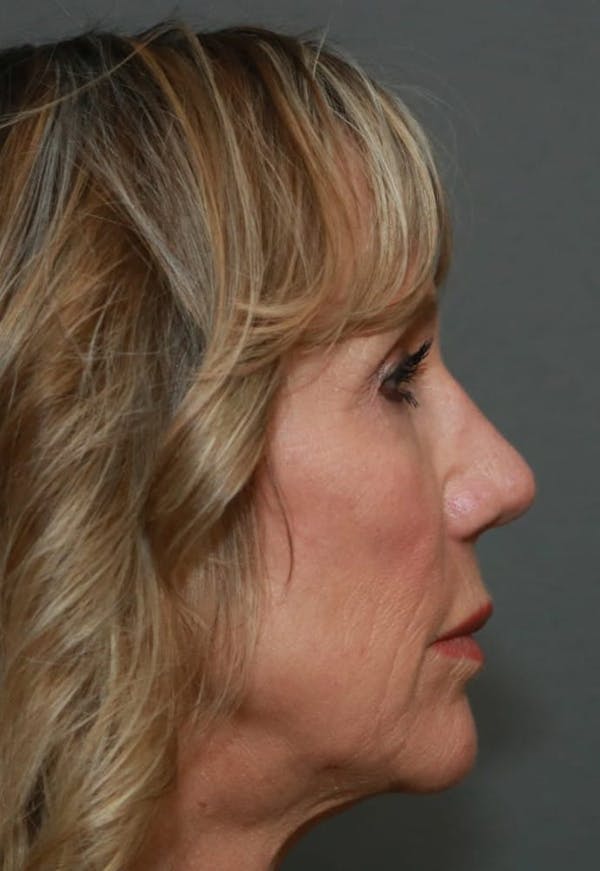 Revision Rhinoplasty Before & After Gallery - Patient 5164616 - Image 6