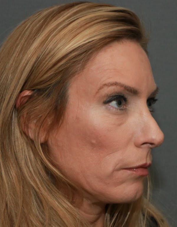 Revision Rhinoplasty Gallery - Patient 5164617 - Image 3