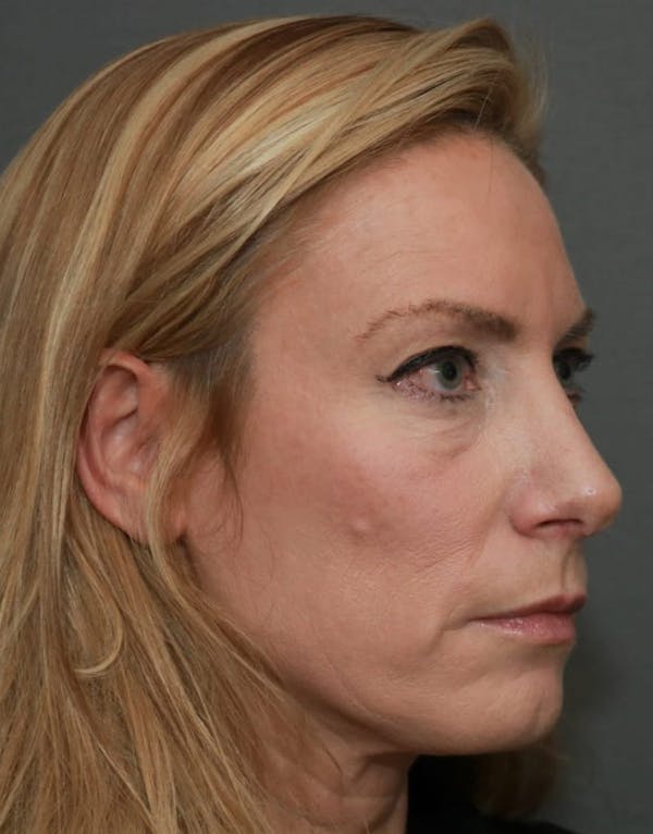 Revision Rhinoplasty Gallery - Patient 5164617 - Image 4