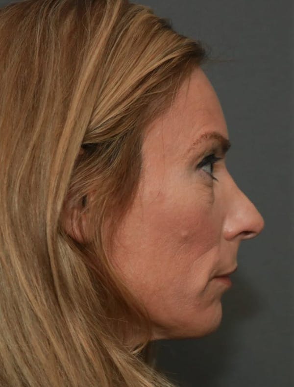 Revision Rhinoplasty Gallery - Patient 5164617 - Image 5