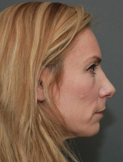 Revision Rhinoplasty Gallery - Patient 5164617 - Image 6