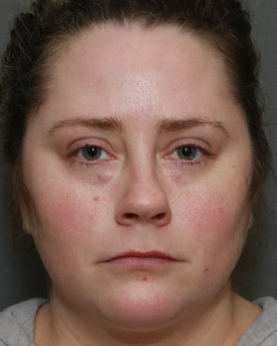 Aesthetic Rhinoplasty Before & After Gallery - Patient 5282749 - Image 1