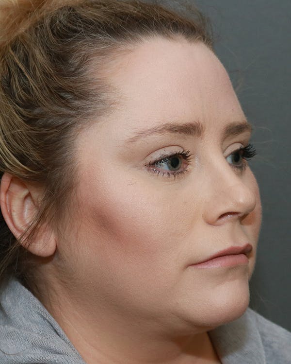 Aesthetic Rhinoplasty Before & After Gallery - Patient 5282749 - Image 4