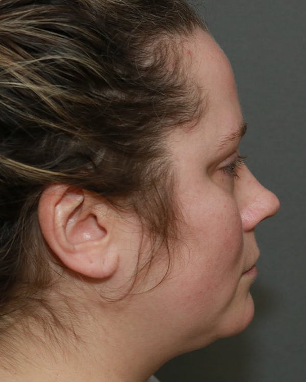 Aesthetic Rhinoplasty Before & After Gallery - Patient 5282749 - Image 5