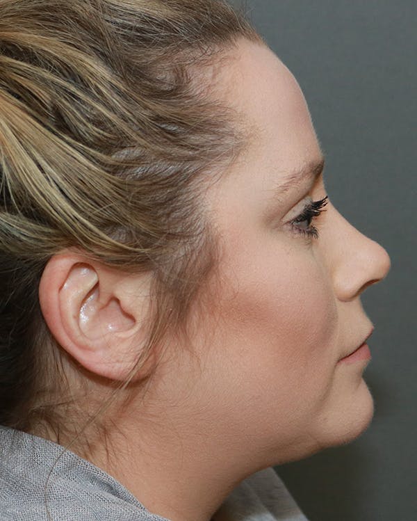 Aesthetic Rhinoplasty Before & After Gallery - Patient 5282749 - Image 6